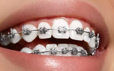 Getting Fixed Braces Fitted: What to Expect