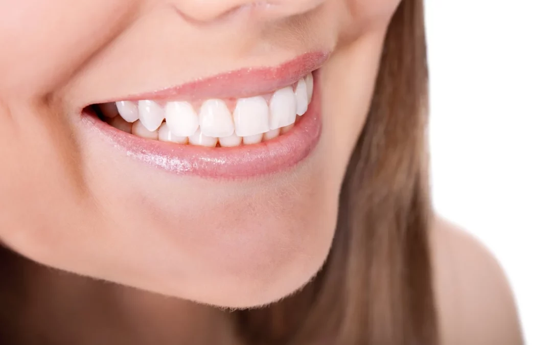 Dental Bridges and Teeth Whitening: What You Need to Know